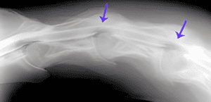 A picture of the shoulder bone with an arrow pointing to it.