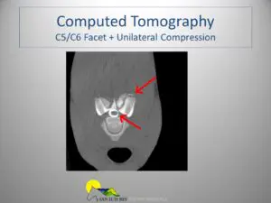 Computed tomography of the face and unilateral compression